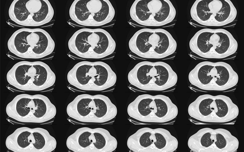 A-computed-tomography-scan-of-lungs-805x503